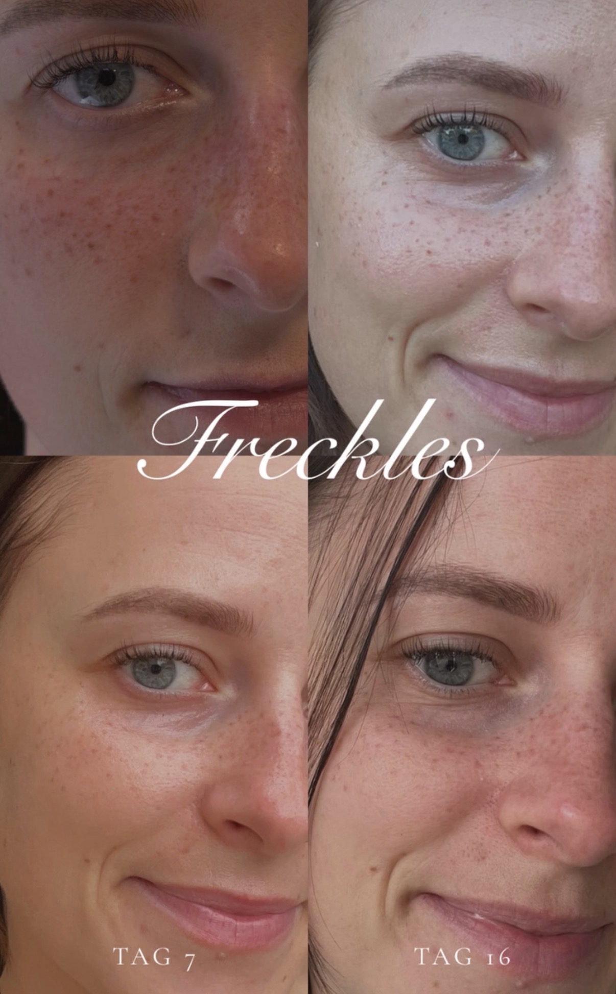 Freckles Ergebnis